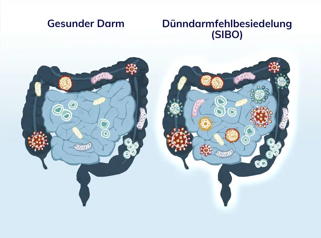 Was ist SIBO – Spooky2 Rife