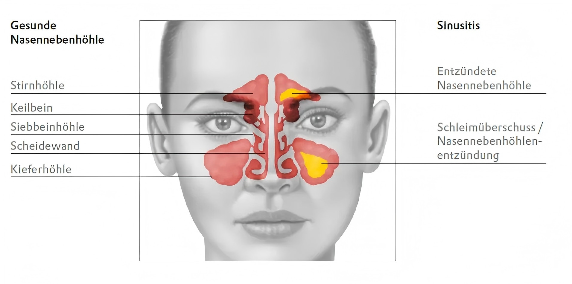 grafik-sinusitis-nasennebenhoelenentzuendung